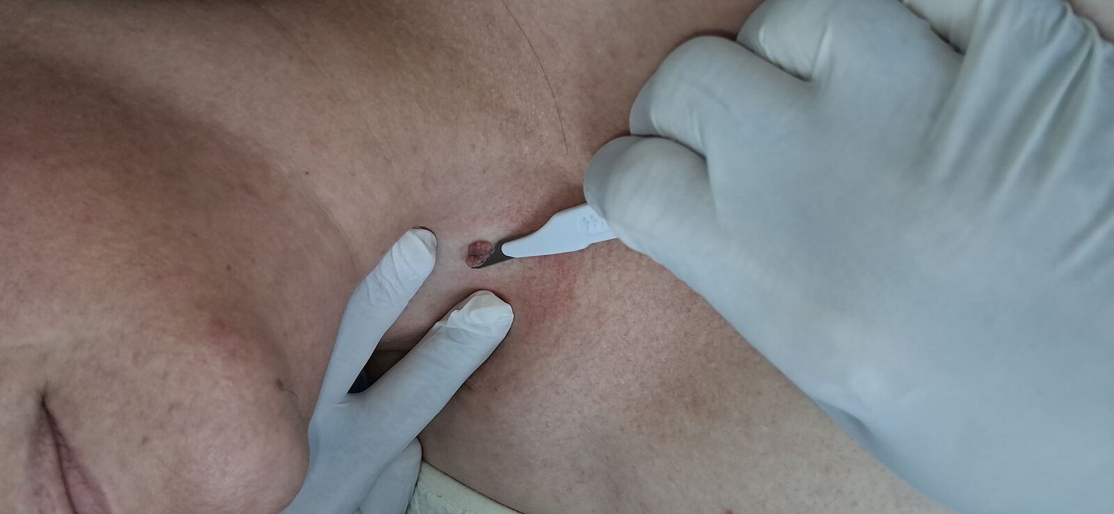 Nevus verrucoso: imagen antes