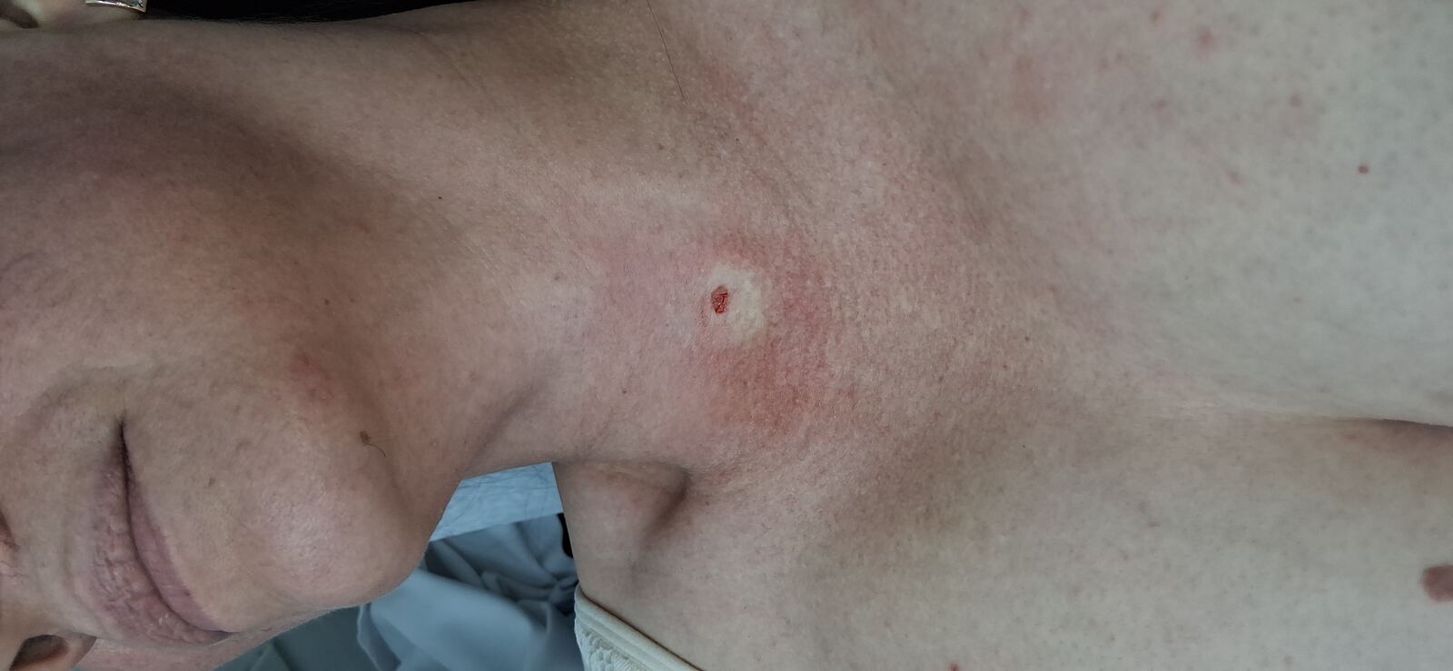 Nevus verrucoso: imagen después