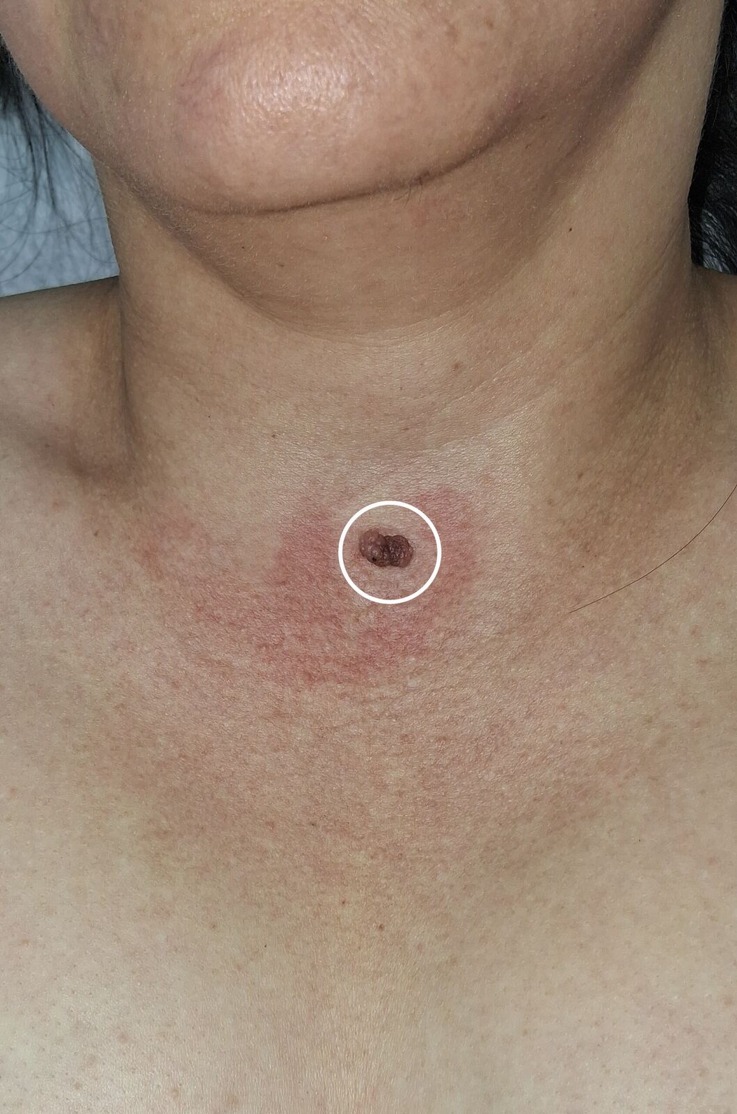 Caso clínico de Nevus verrucoso