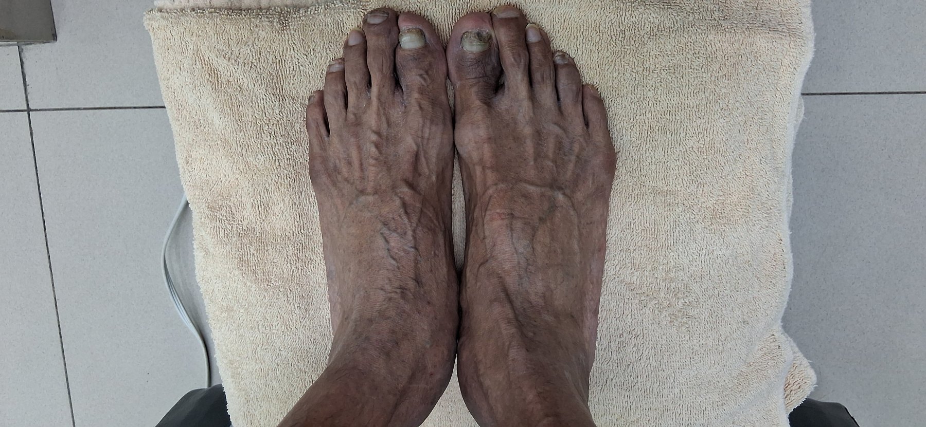 Onicomicosis en manos y pies: imagen antes