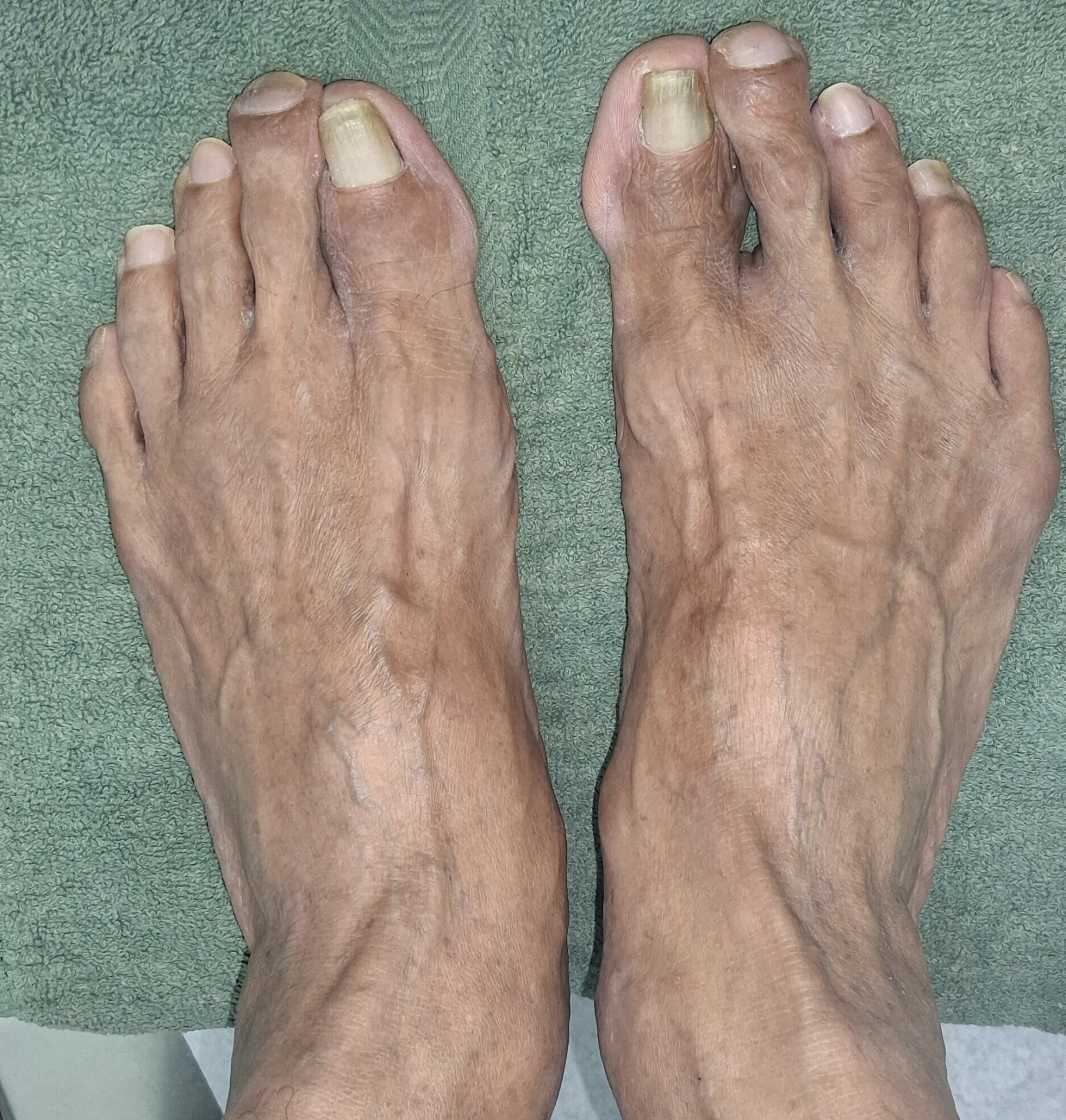 Onicomicosis en manos y pies: imagen después