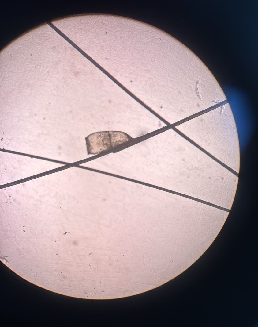 Pediculosis: imagen después