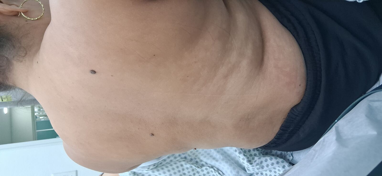 Caso clínico de Pitiriasis alba