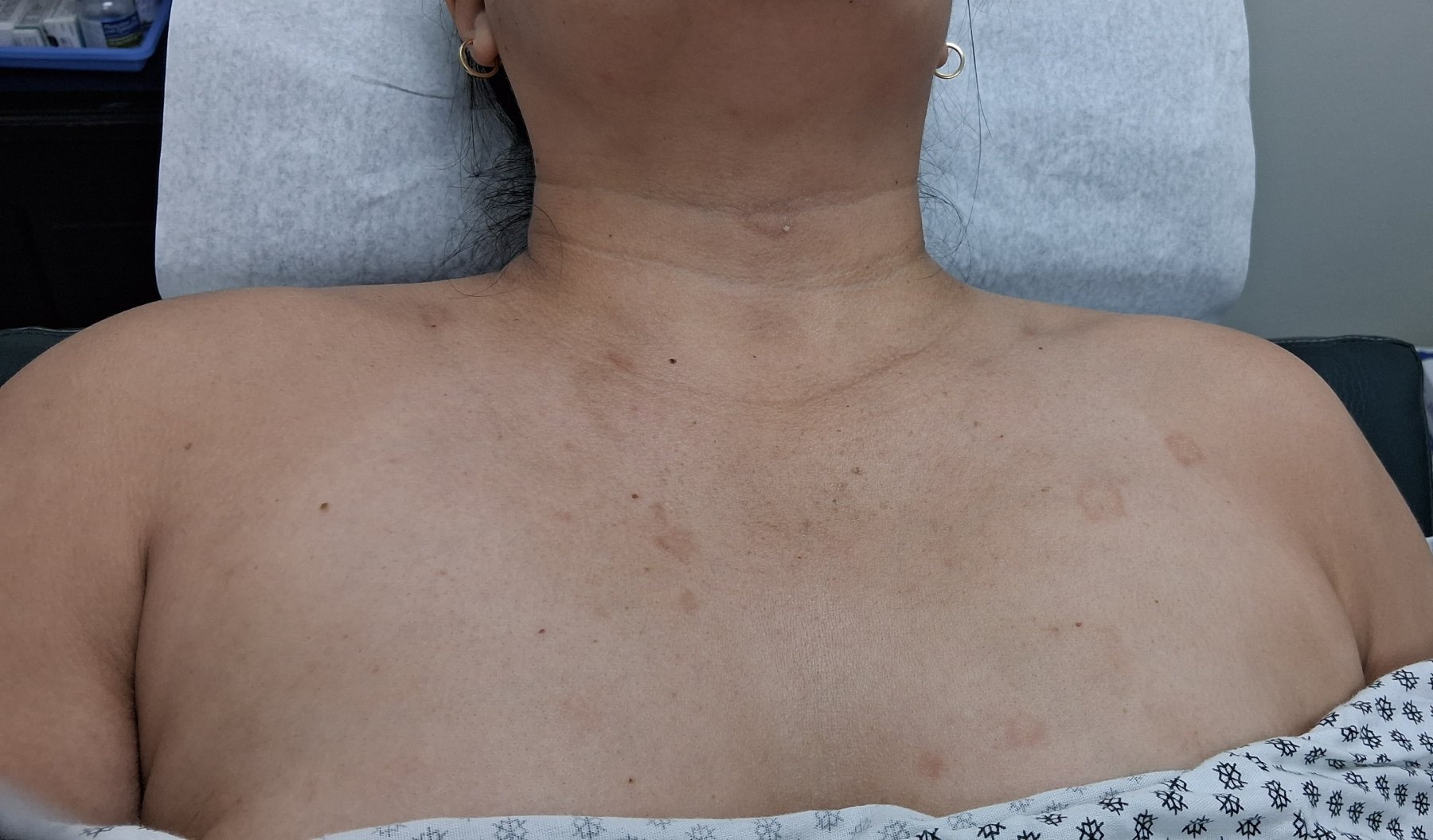 Pitiriasis rosada: imagen antes