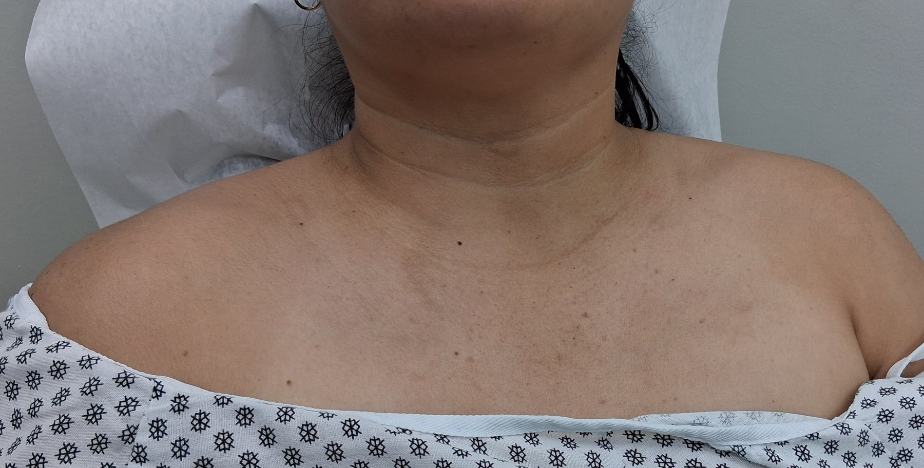 Pitiriasis rosada: imagen después