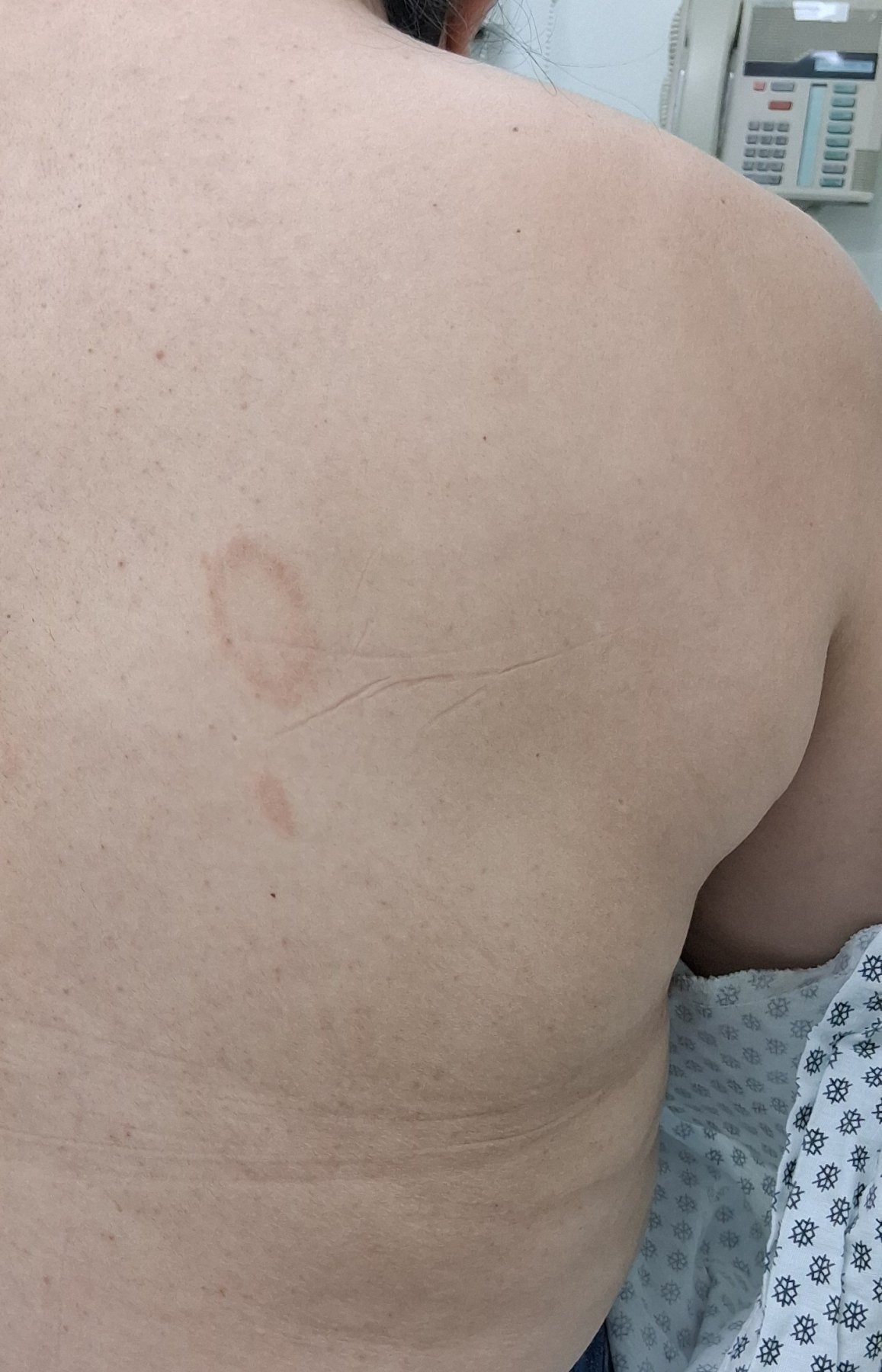 Caso clínico de Pitiriasis rosada