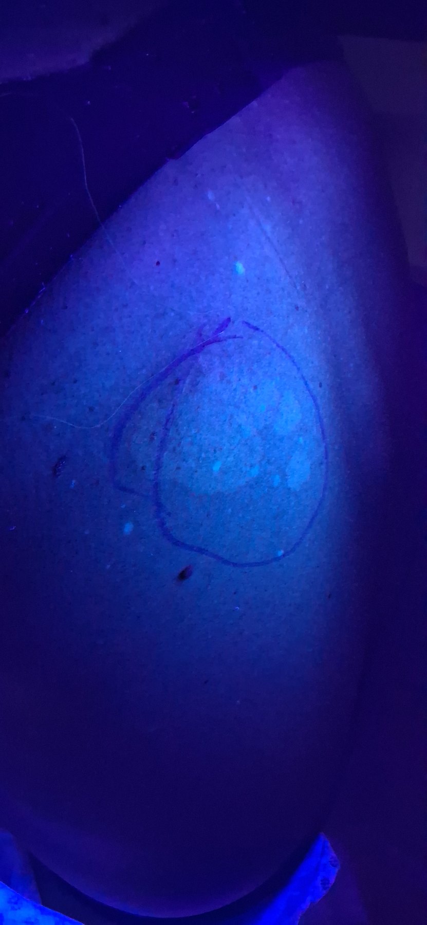 Pitiriasis versicolor e hipomelanosis guttata: imagen antes