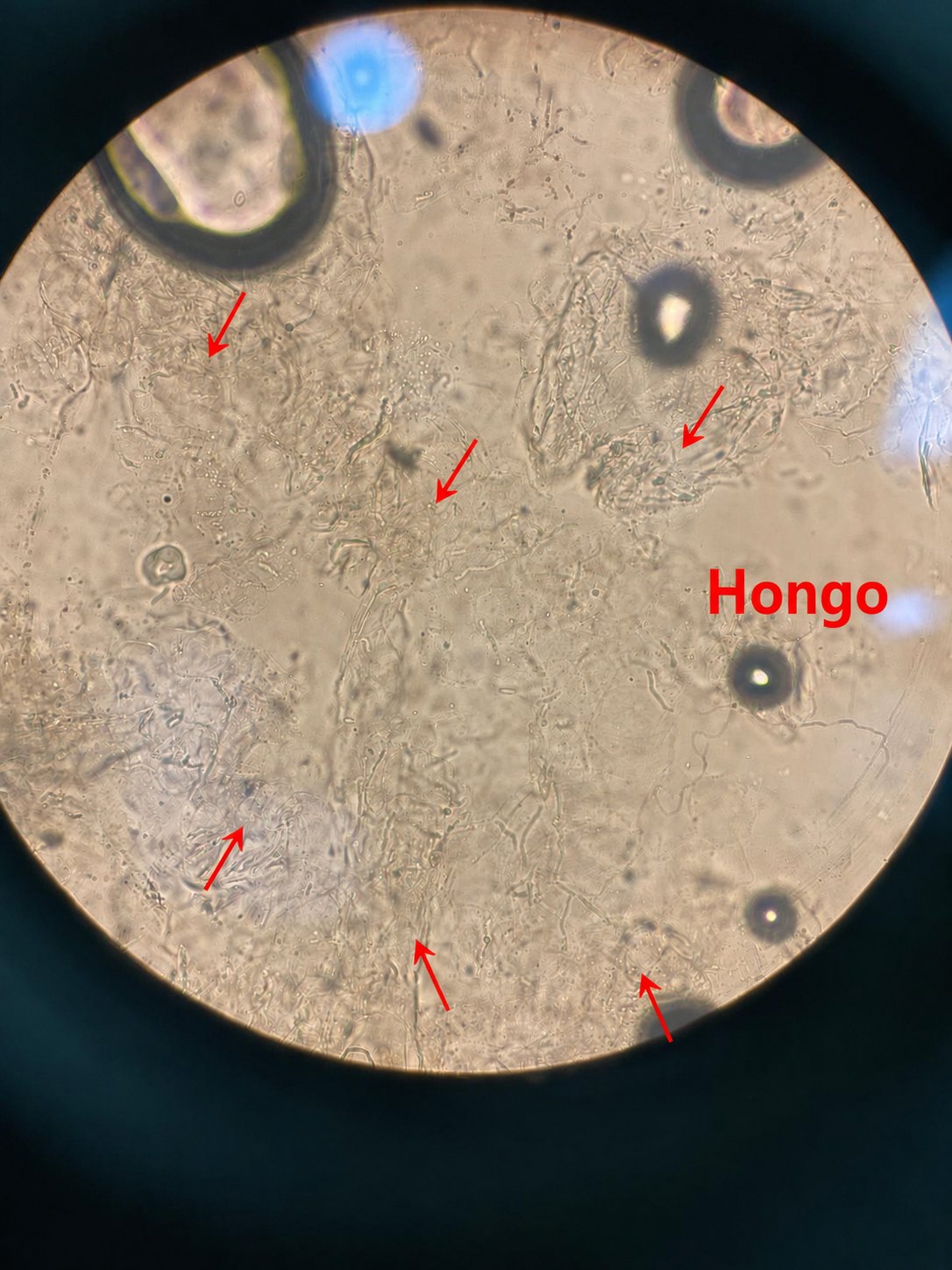 Caso clínico de Pitiriasis versicolor e hipomelanosis guttata