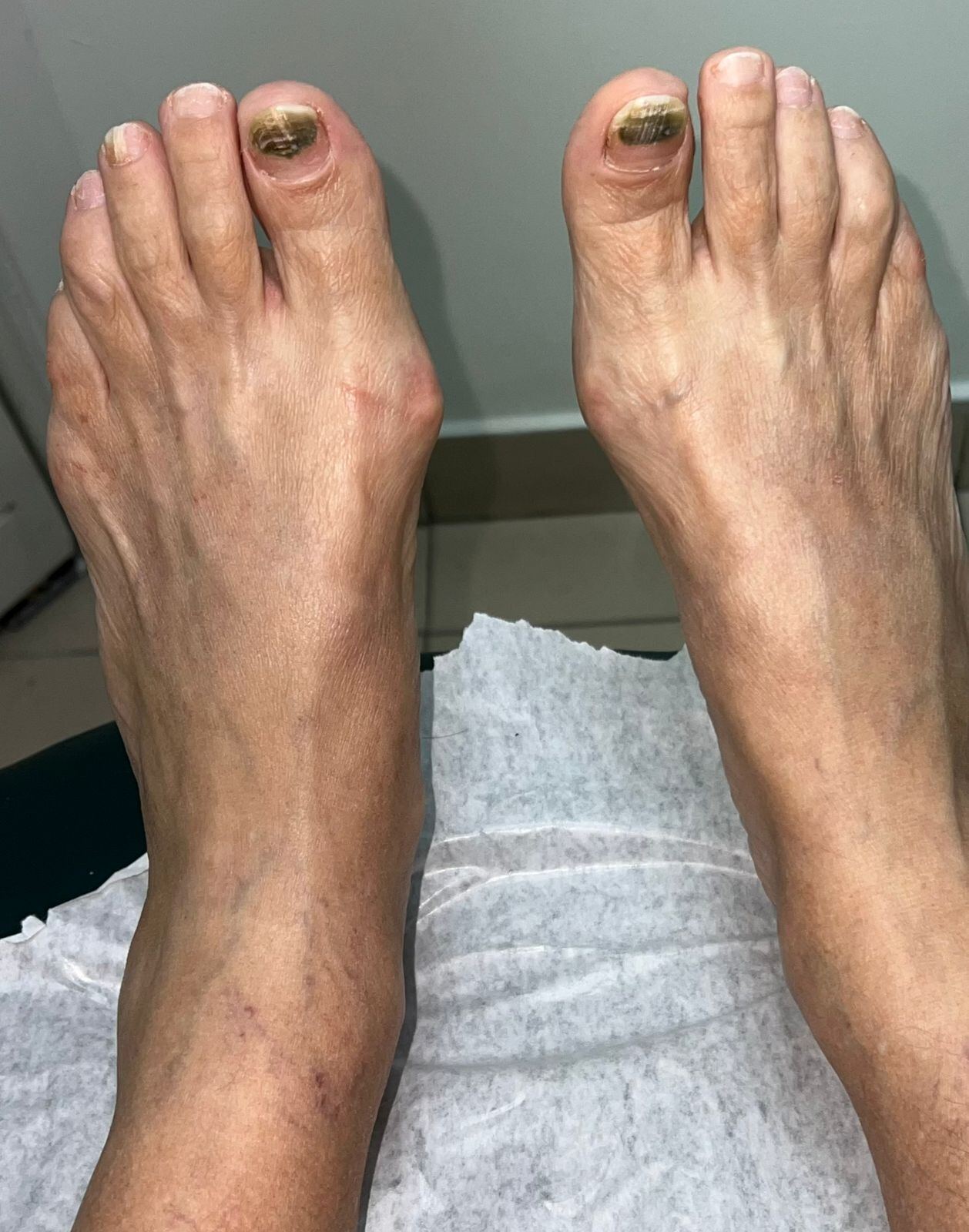 Pseudomonas subungueal: imagen después