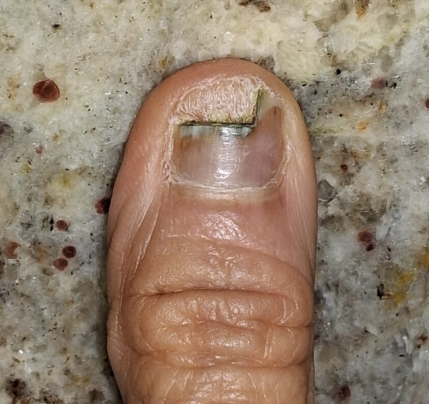 Caso clínico de Pseudomonas