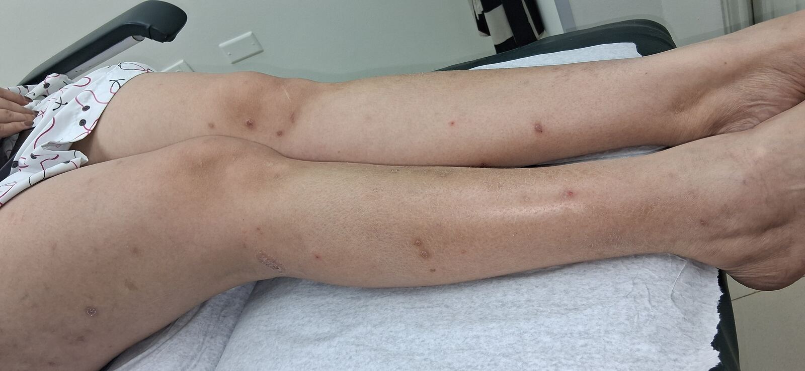 Psoriasis guttata: imagen antes