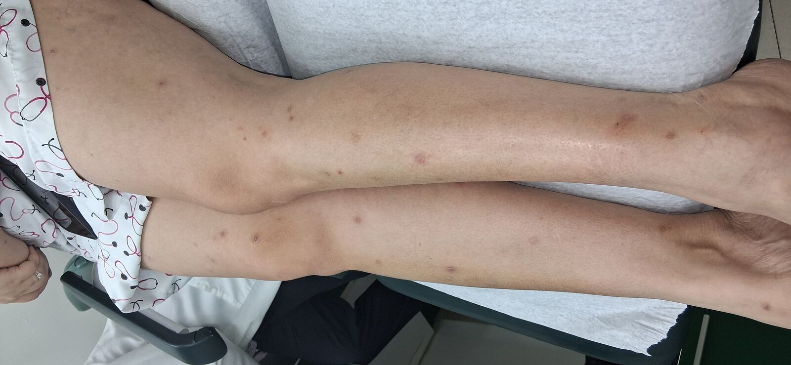 Psoriasis guttata: imagen después