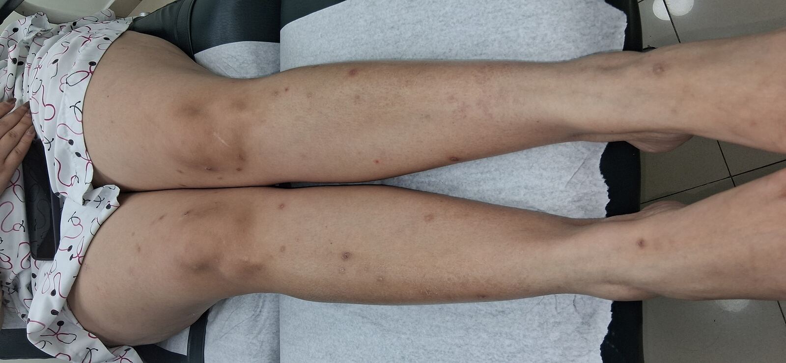 Caso clínico de Psoriasis guttata