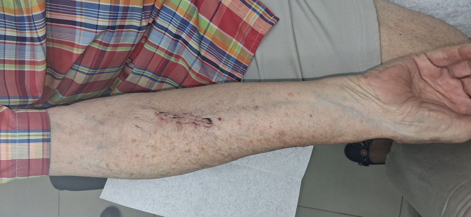 Queratoacantoma: imagen antes
