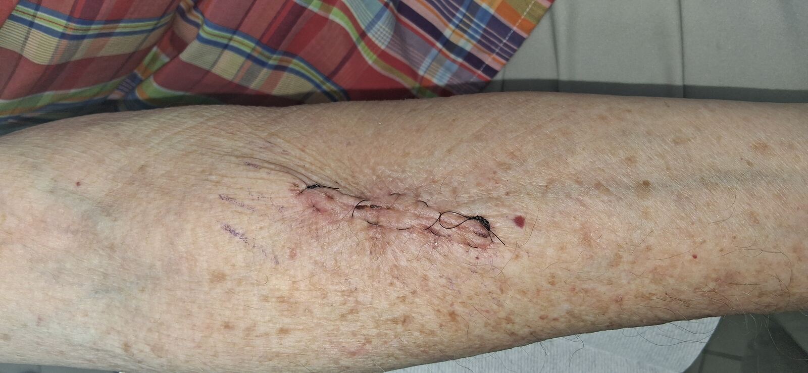 Queratoacantoma: imagen después