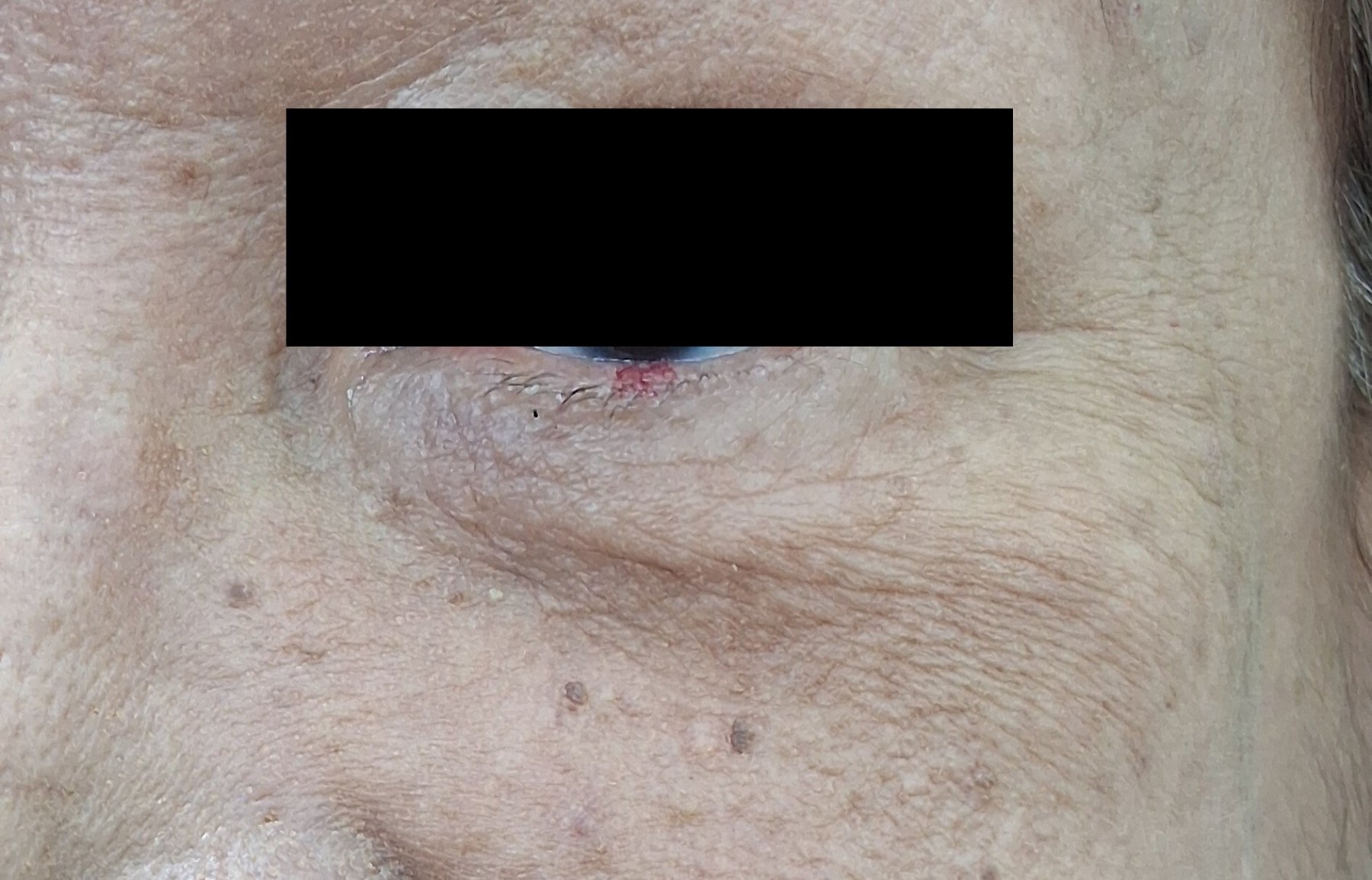 Queratosis actínica: imagen antes