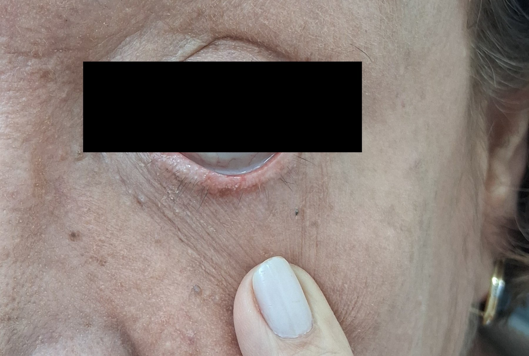 Queratosis actínica: imagen después