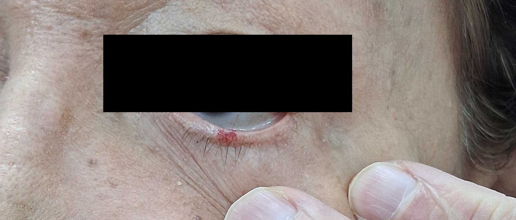 Caso clínico de Queratosis actínica