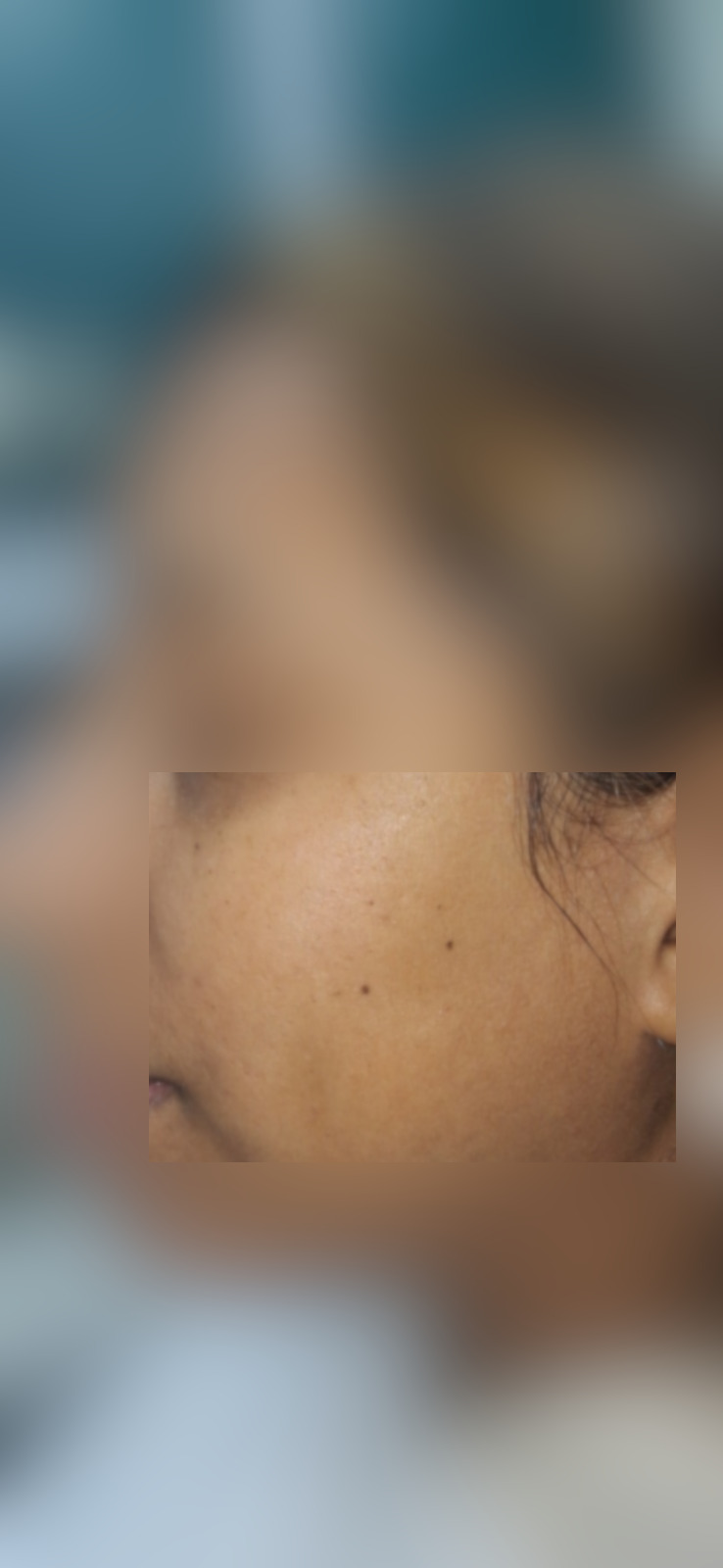 Queratosis seborreica: imagen antes