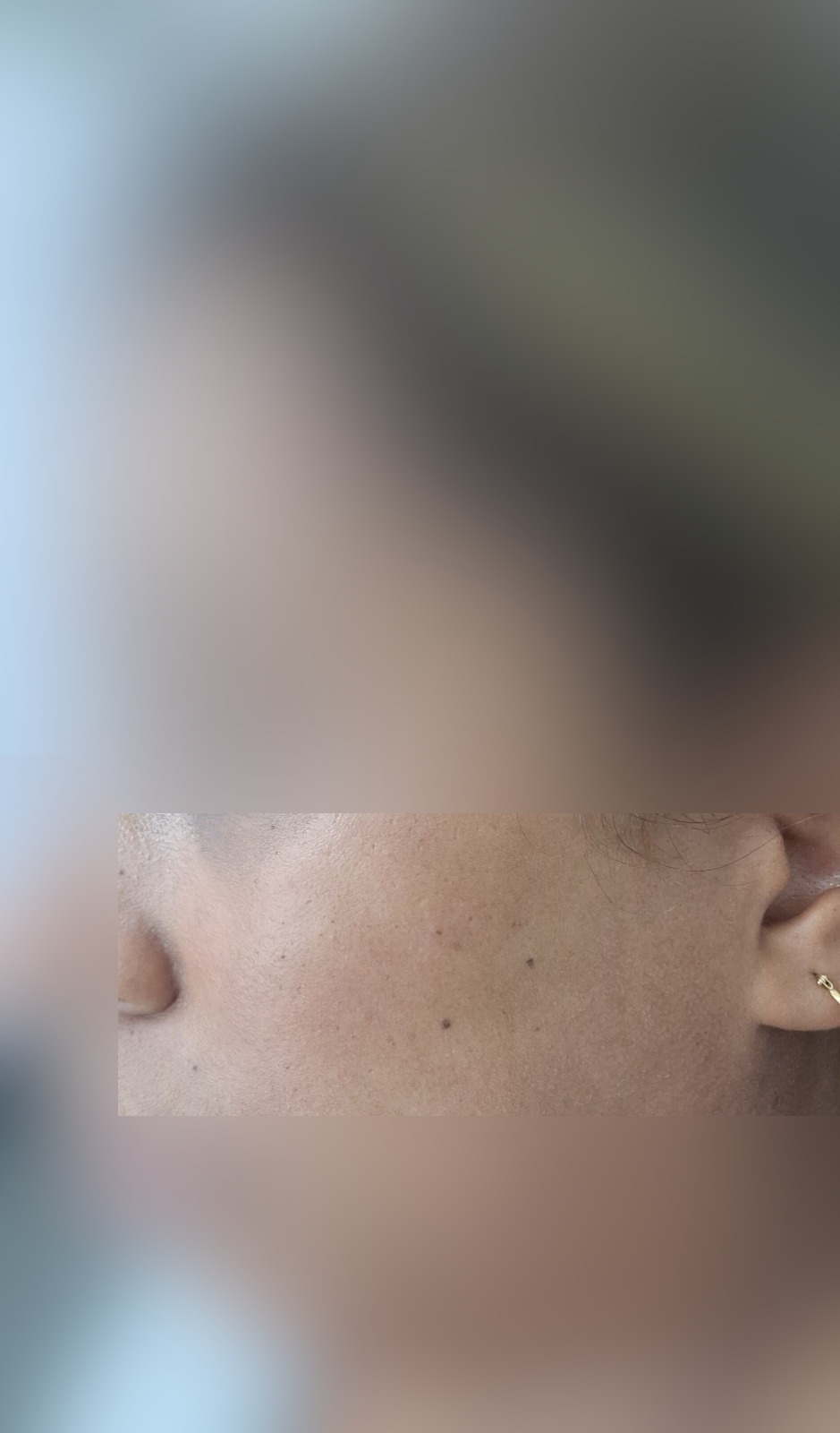 Queratosis seborreica: imagen después