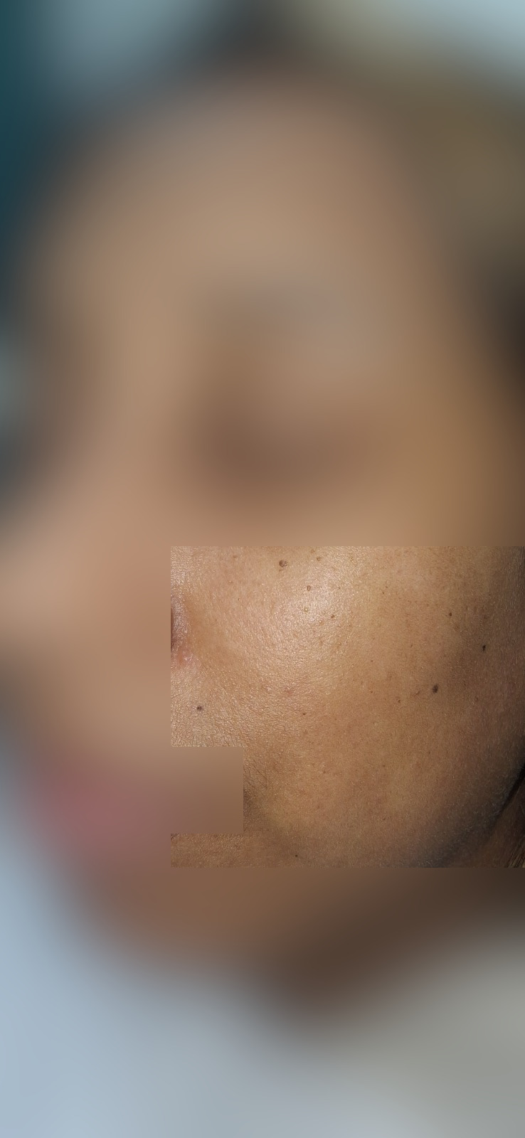 Caso clínico de Queratosis seborreica