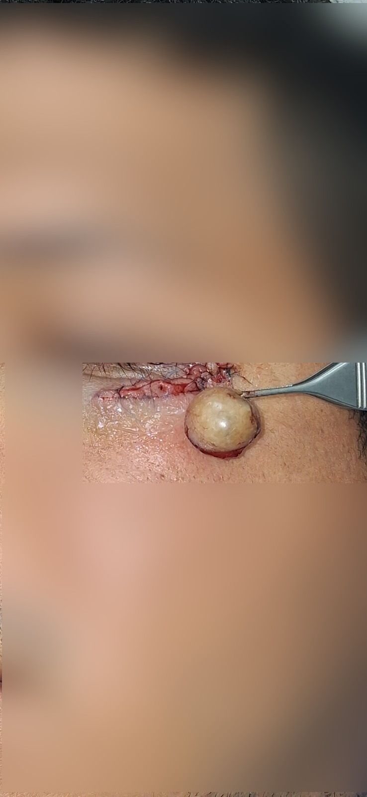 Quiste epidermoide: imagen antes