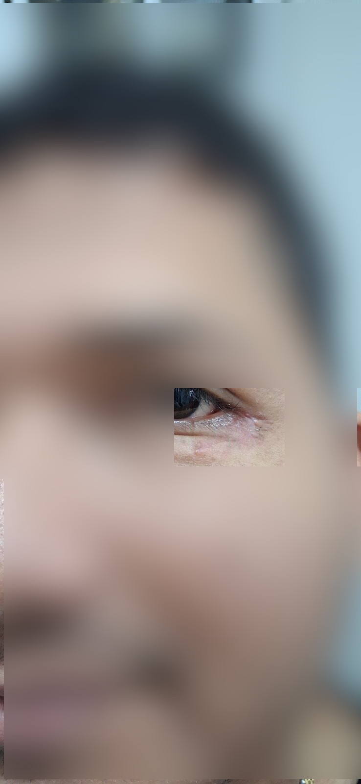 Quiste epidermoide: imagen después