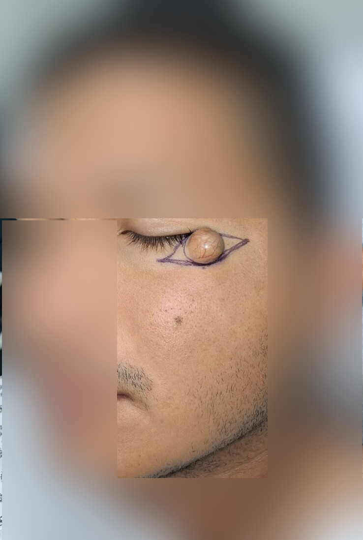 Caso clínico de Quiste epidermoide