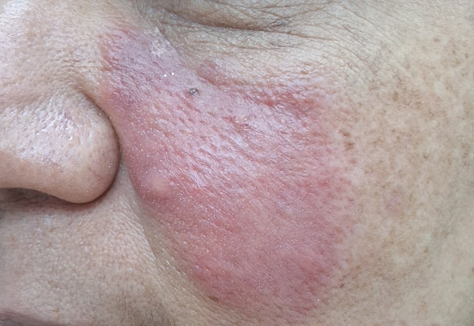 Rosácea eritematosa: imagen antes