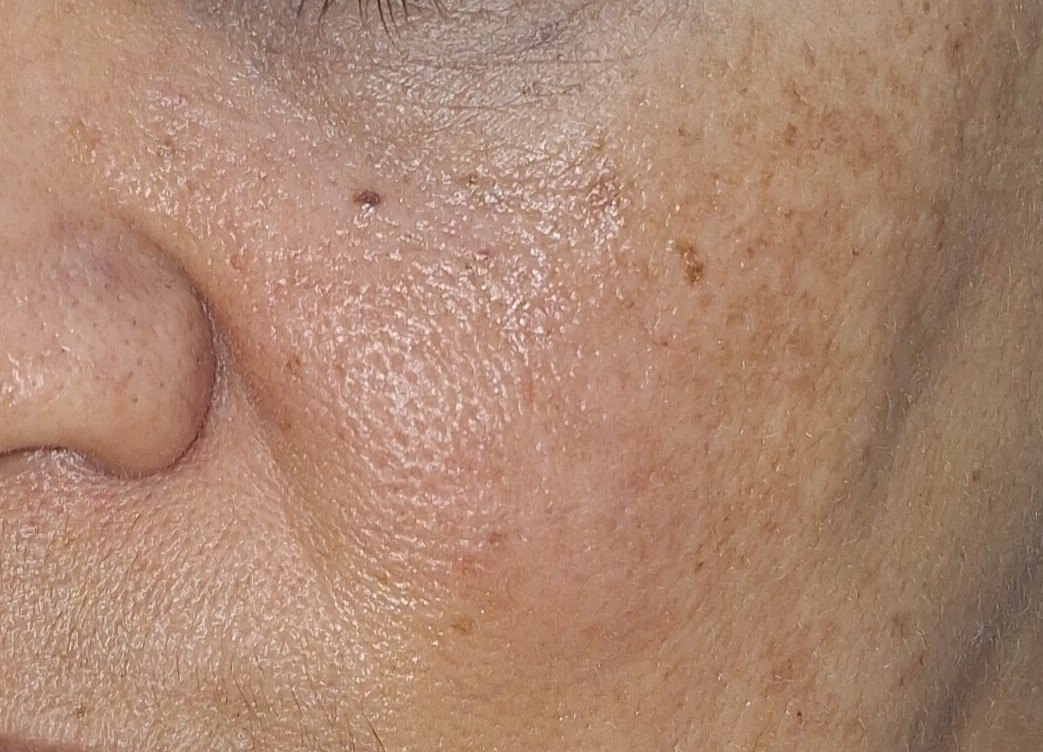 Rosácea eritematosa: imagen después
