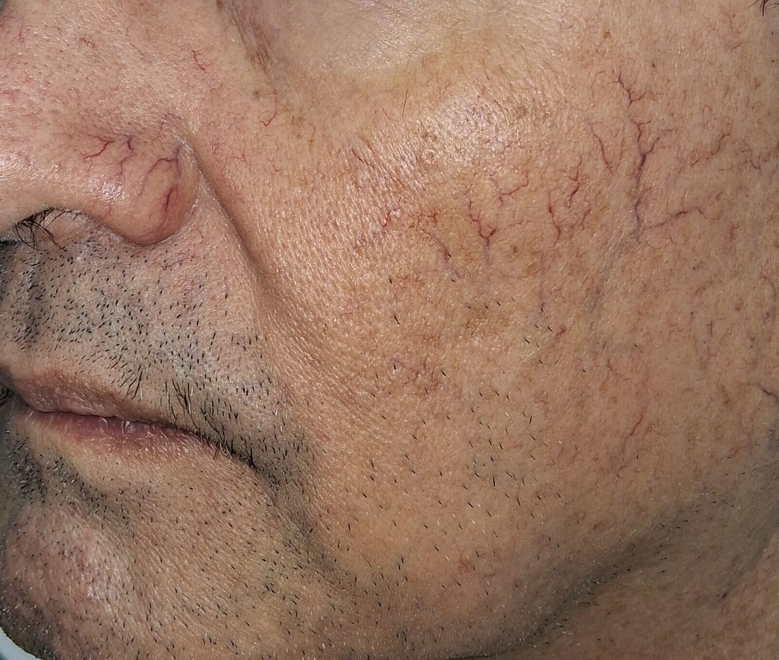Rosácea telangiectásica y Demodex: imagen antes