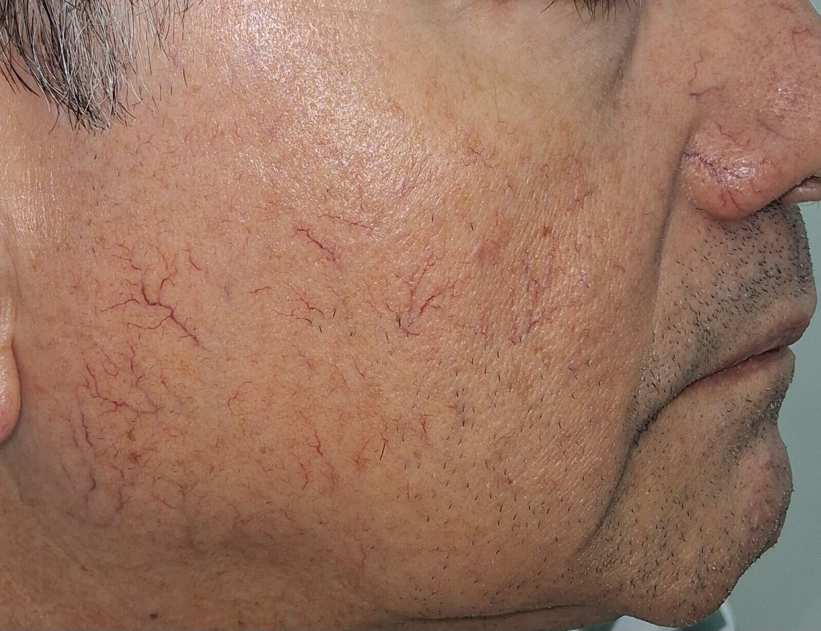 Rosácea telangiectásica y Demodex: imagen después