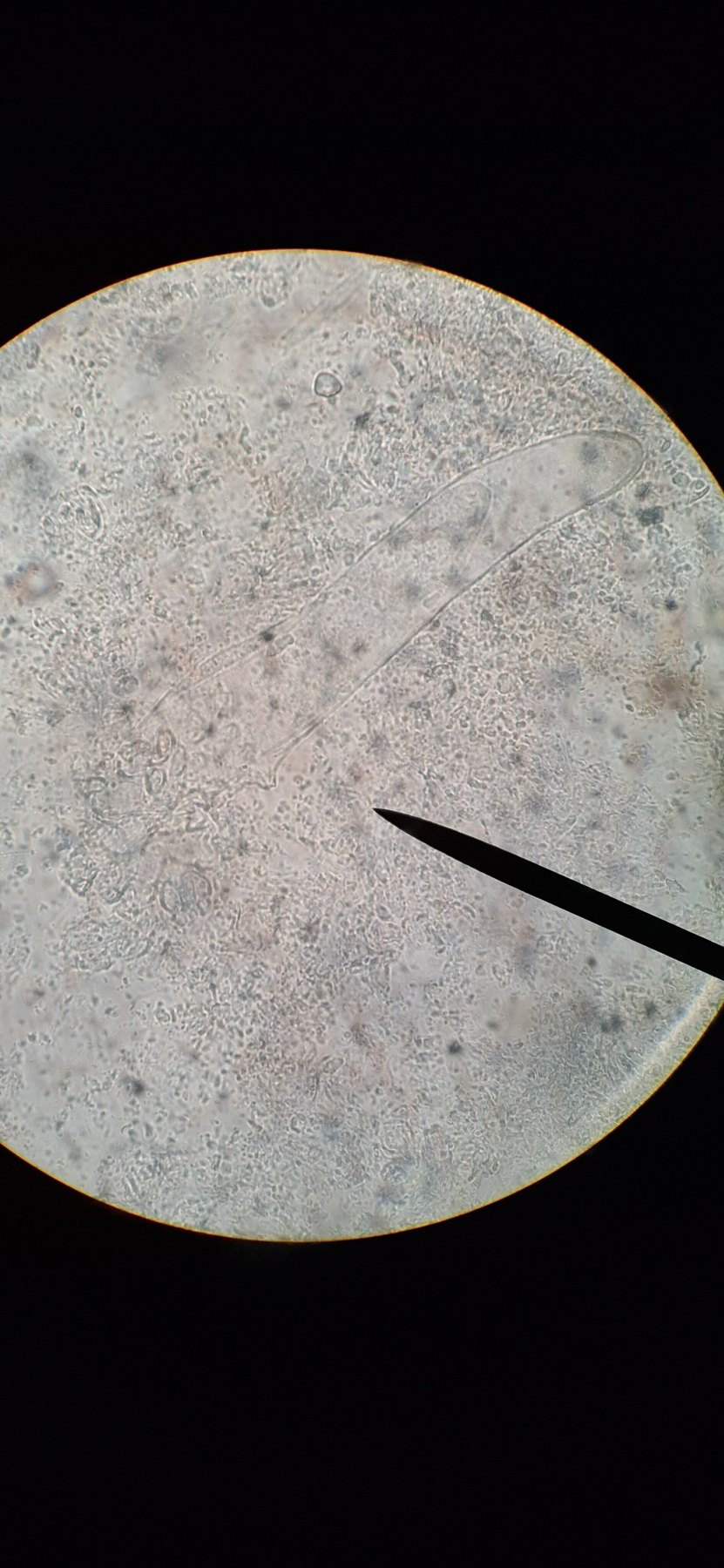 Caso clínico de Rosácea telangiectásica y Demodex