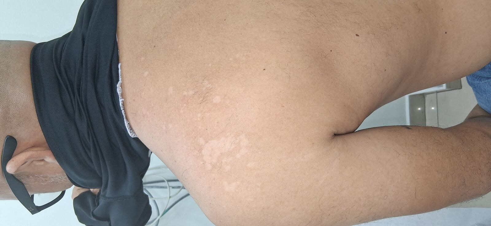 Tiña versicolor: imagen antes