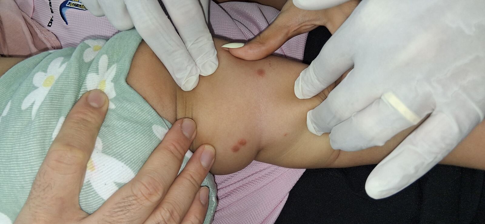 Urticaria papular, mastocitosis y linfocitosis cutis: imagen antes