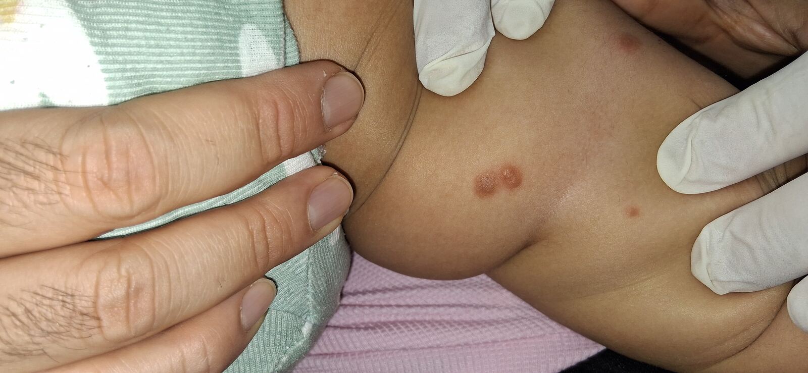 Urticaria papular, mastocitosis y linfocitosis cutis: imagen después