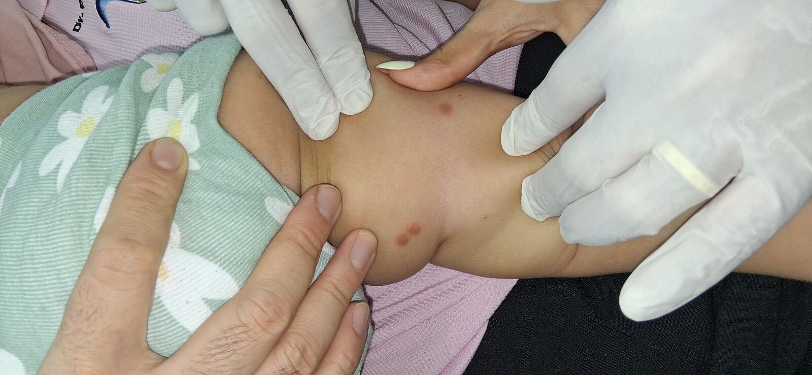 Caso clínico de Urticaria papular, mastocitosis y linfocitosis cutis