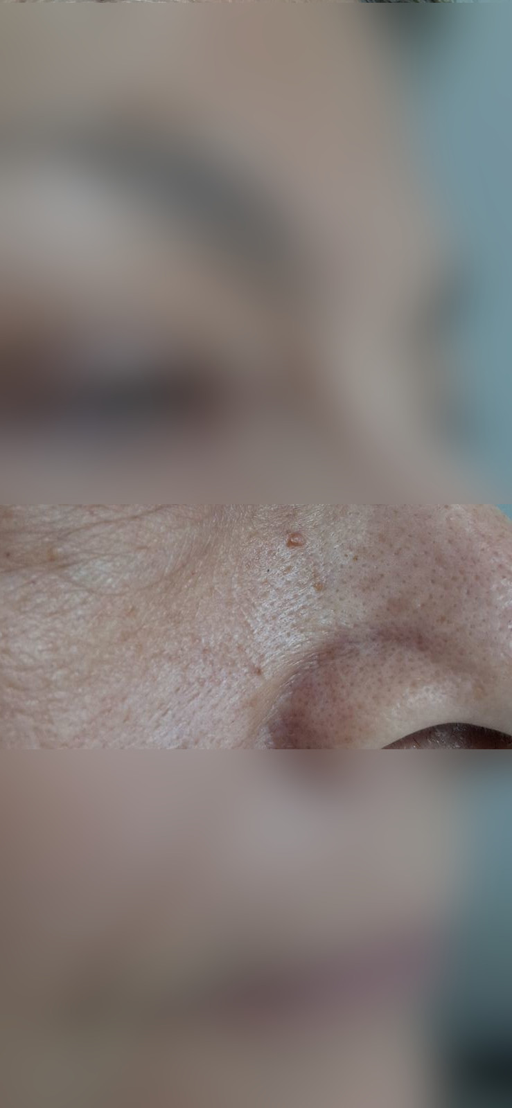Verruga filiforme: imagen después