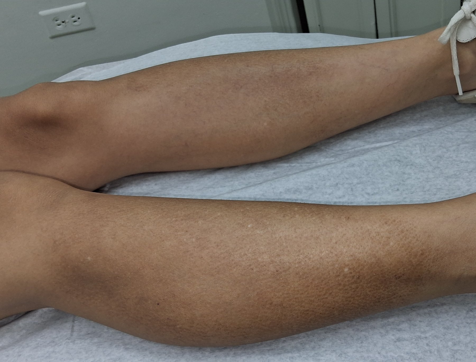 Xerosis: imagen antes