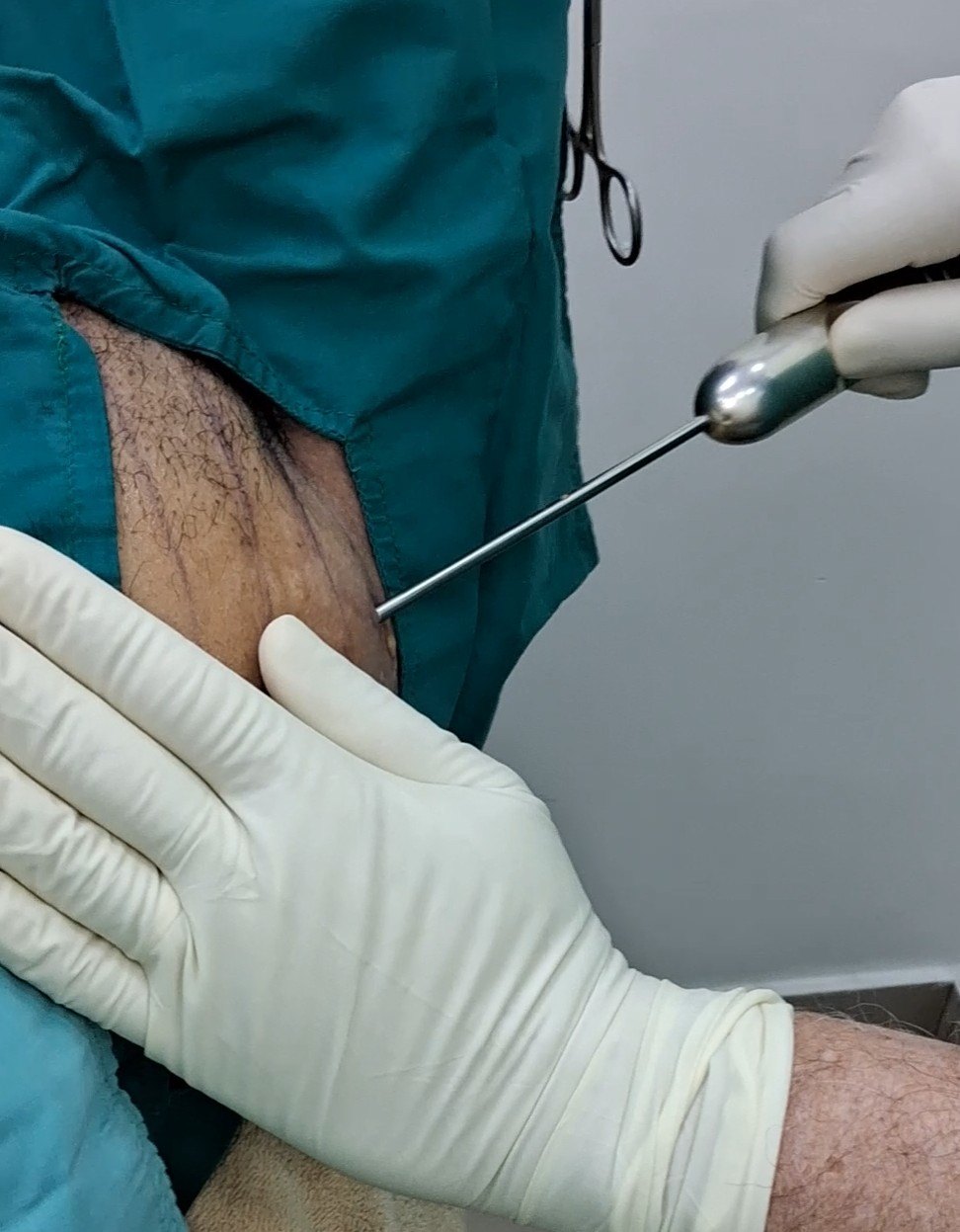 Antes: Lipoma