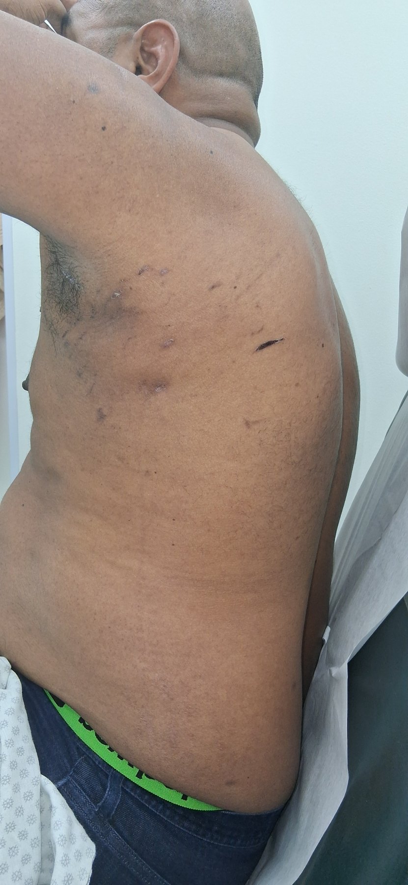 Después: Lipoma