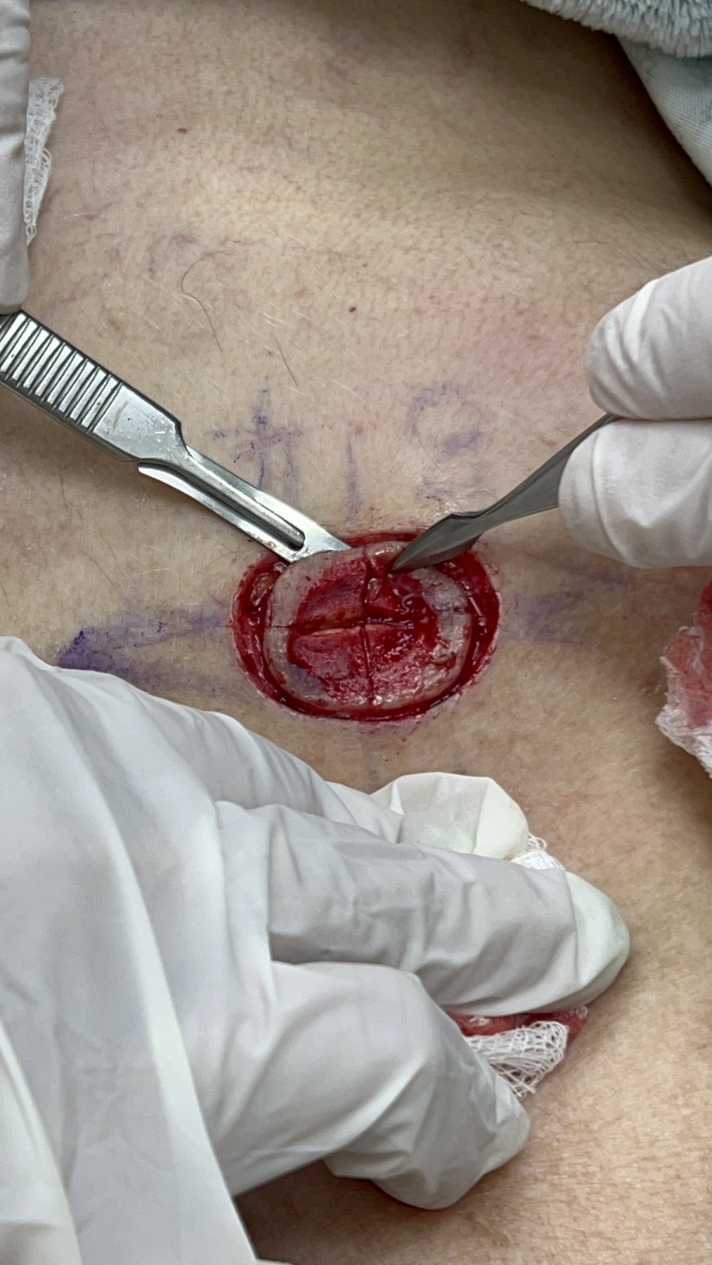 Antes: Cirugía de Mohs con control microscópico y reconstrucción