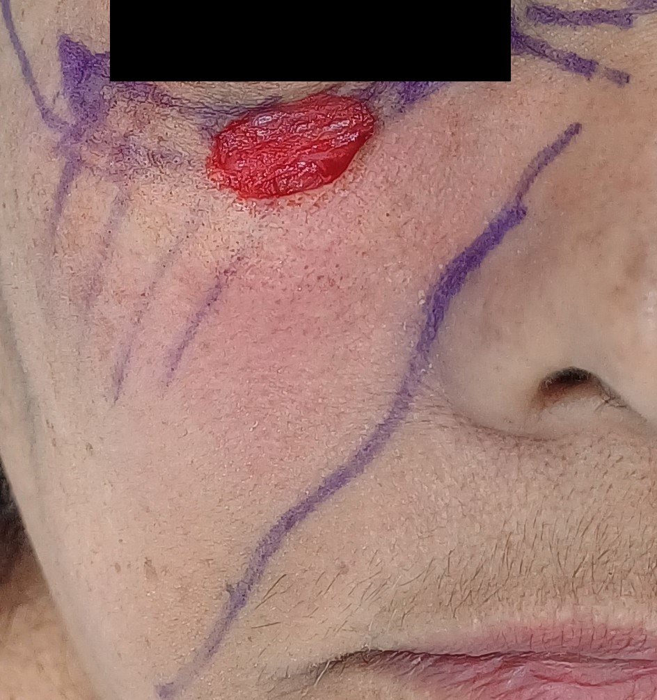 Antes: Cirugía de Mohs con control microscópico  y reconstrucción