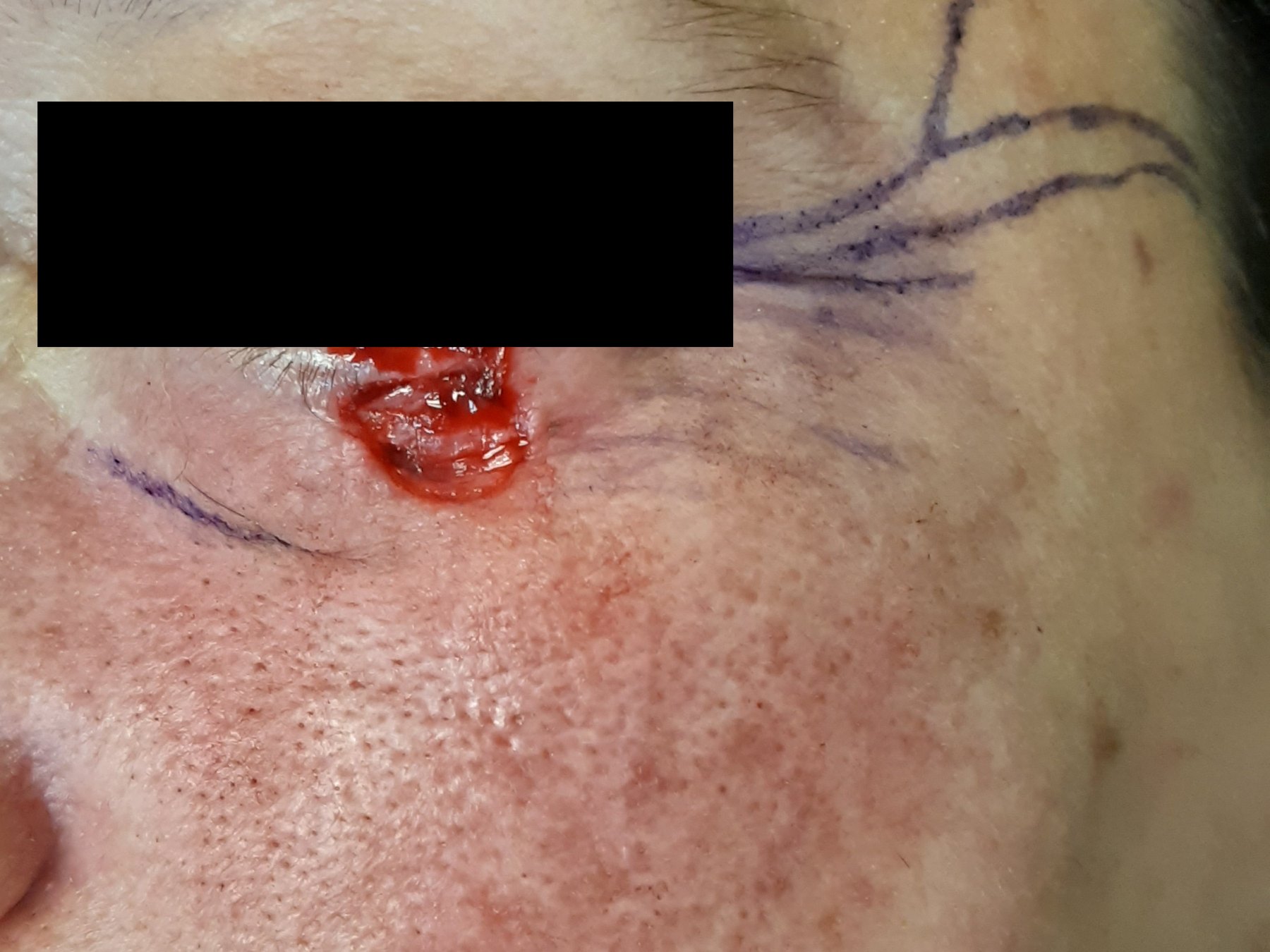 Antes: Cirugía de Mohs con control microscópico  y reconstrucción