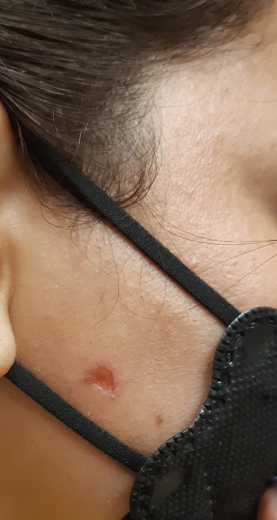 Cirugía de Mohs con control microscópico  y reconstrucción