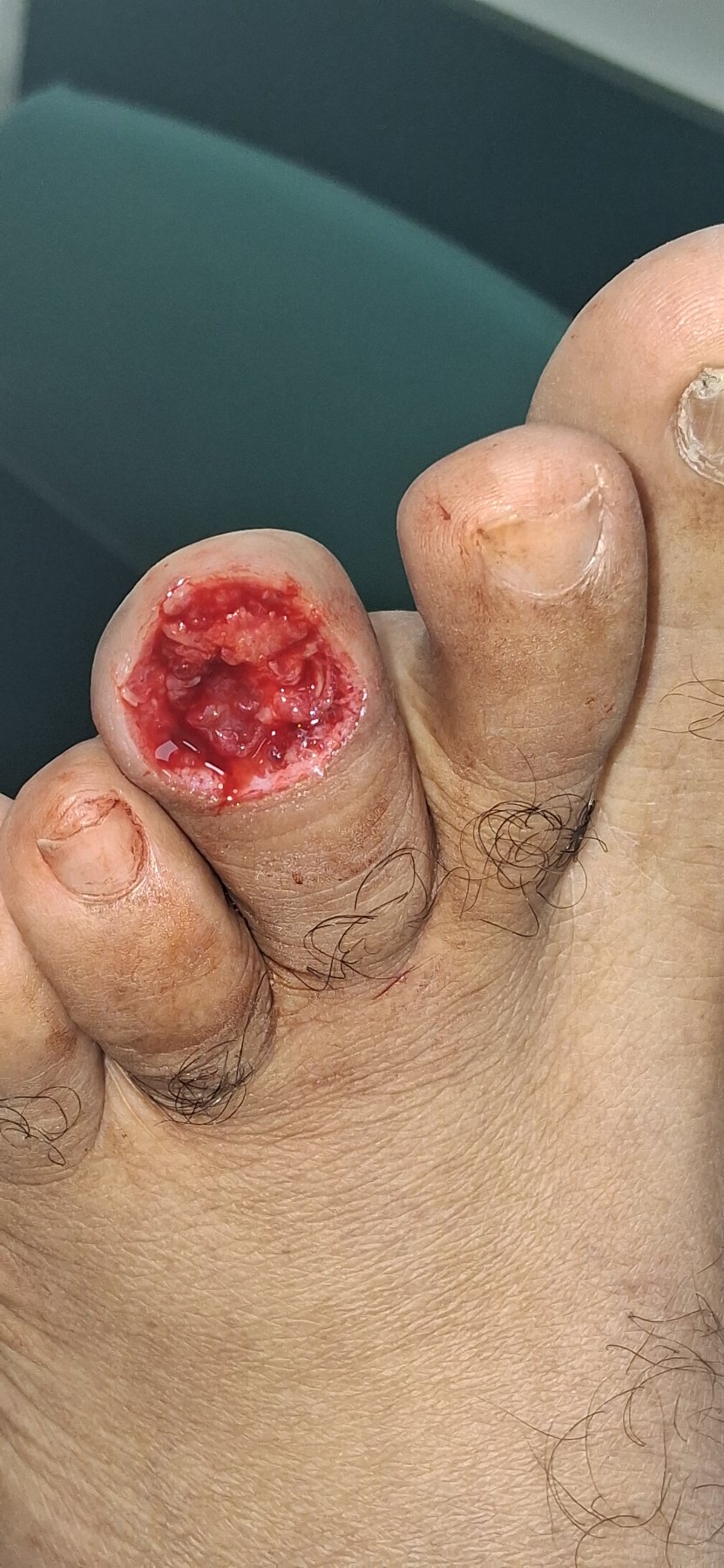 Antes: Tumor Agresivo