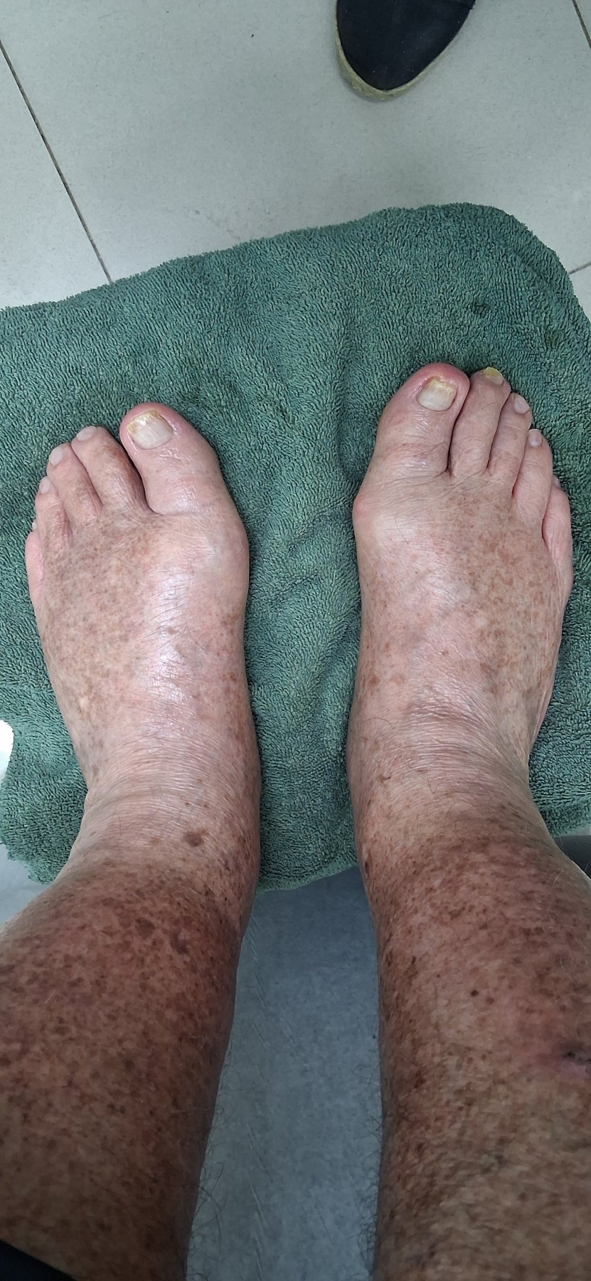 Después: Cuidado de los pies