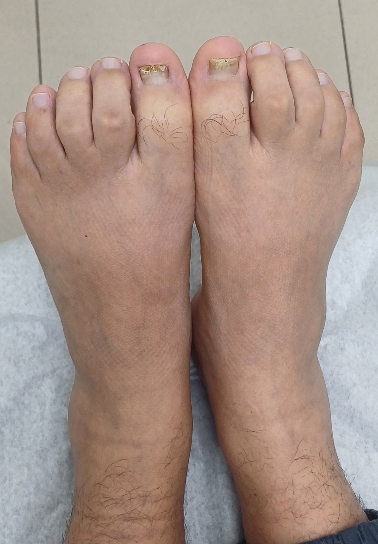 Antes: Onicomicosis del pie